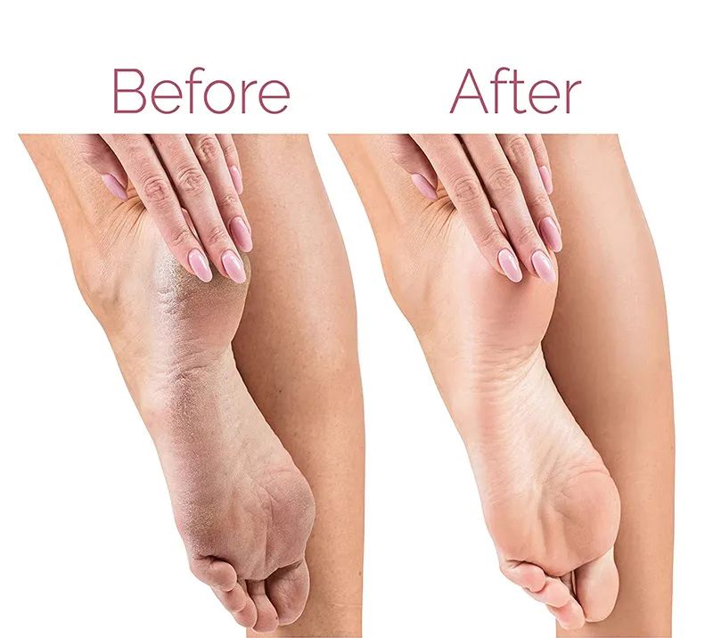 Electric Foot File for Heels Grinding Pedicure Tools Callus Remover USB Rechargeable Professional Foot Care Tool Dead Hard Skin